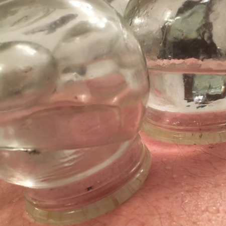 advanced fire cupping